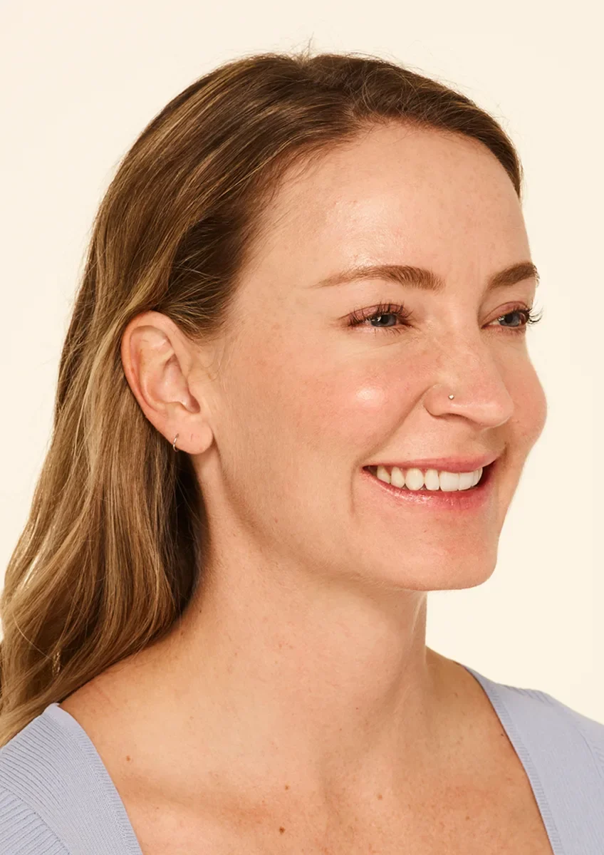 Thirty days after a neuromodulator treatment — softened crow's feet at full smile