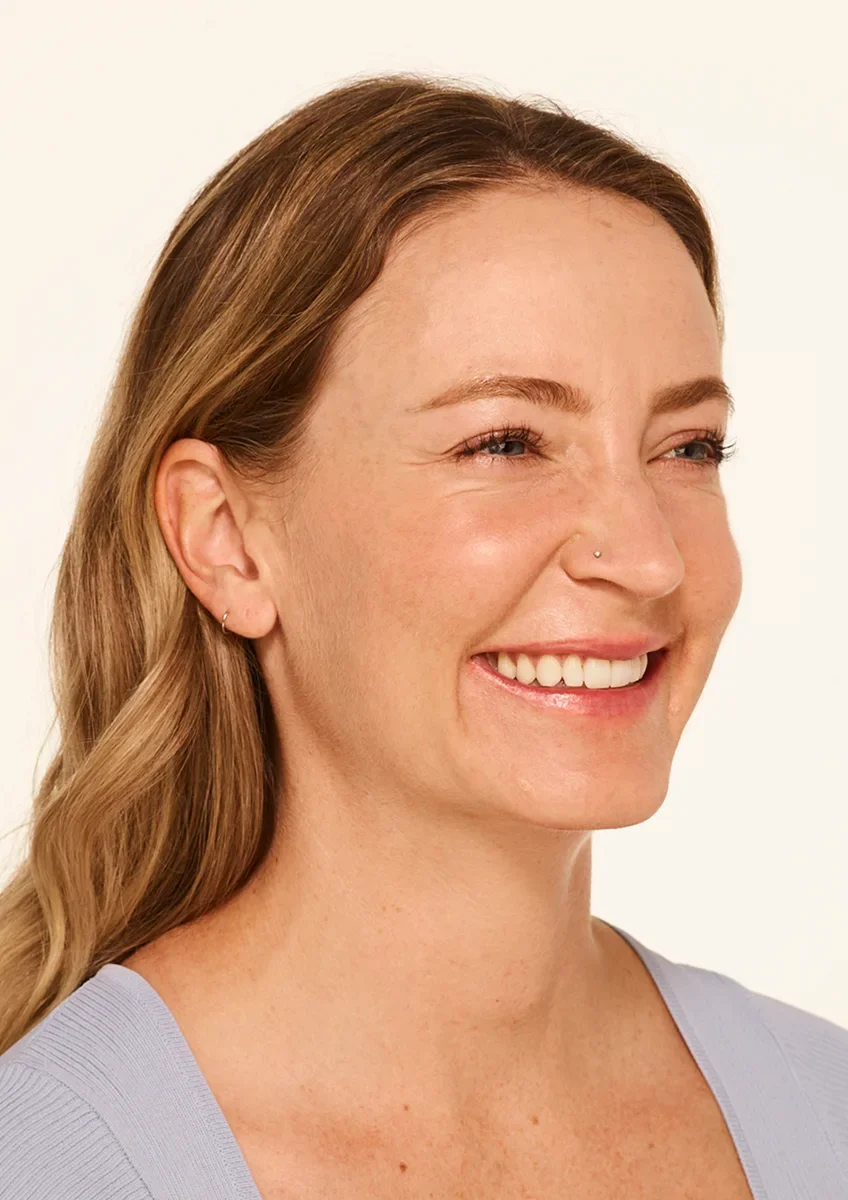 Before a neuromodulator treatment — visible crow's feet at full smile