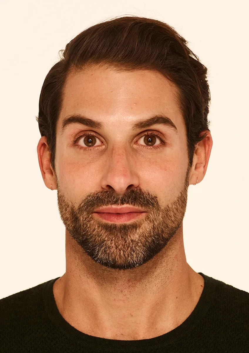 Thirty days after a neuromodulator treatment — smoothed horizontal forehead lines