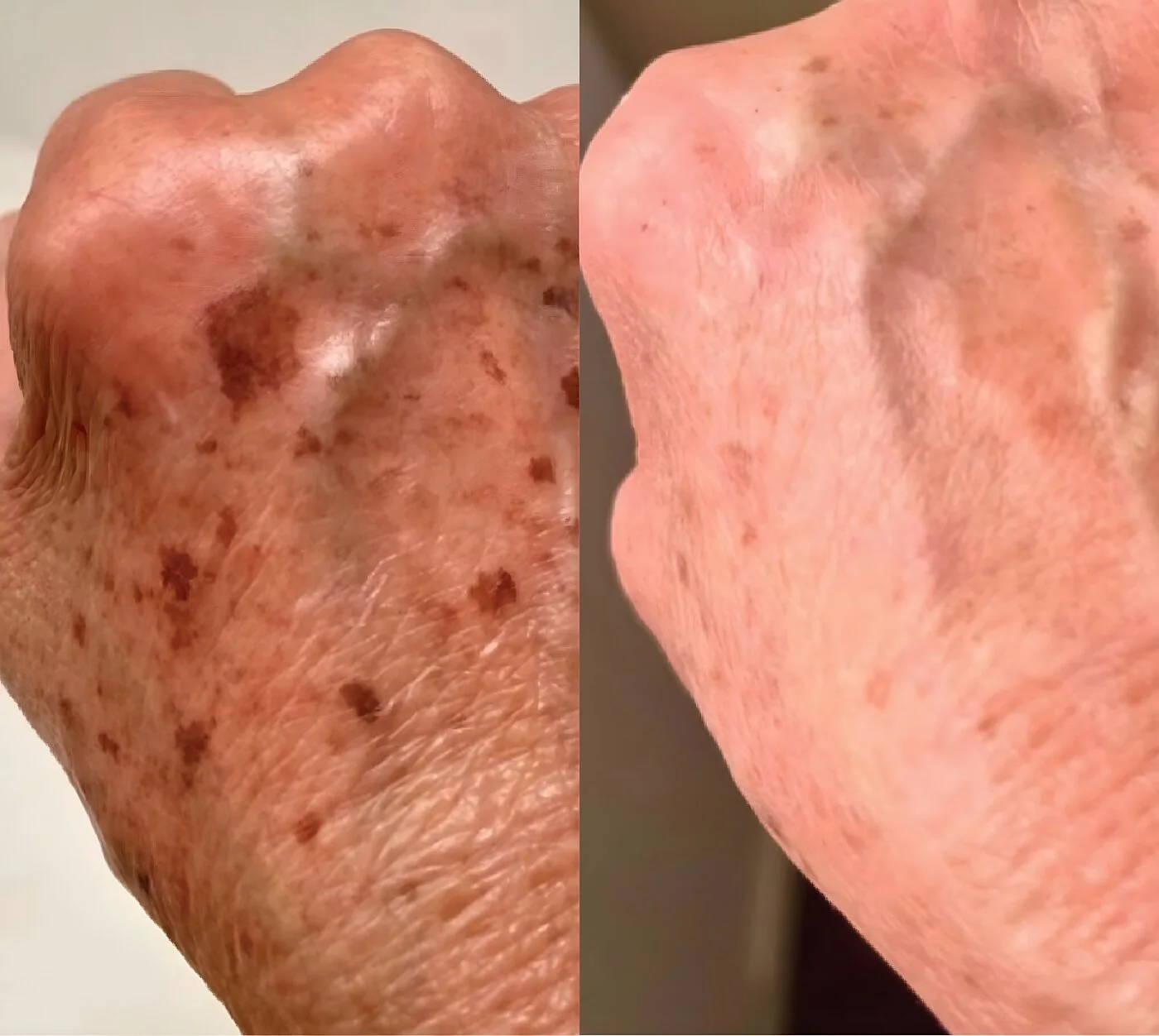 Chemical peel before and after showing sun spots on the back of the hand visibly lightened.