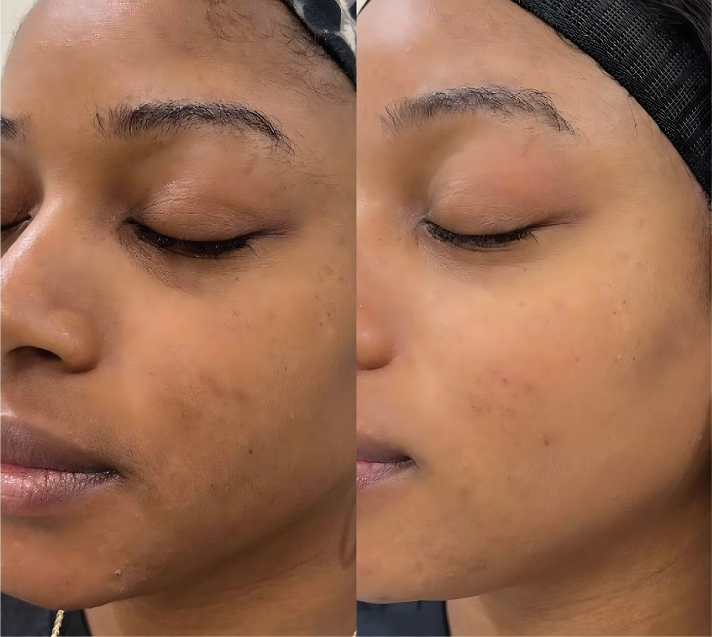 Chemical peel before and after showing cheek melasma and uneven tone brightened to a more uniform complexion.