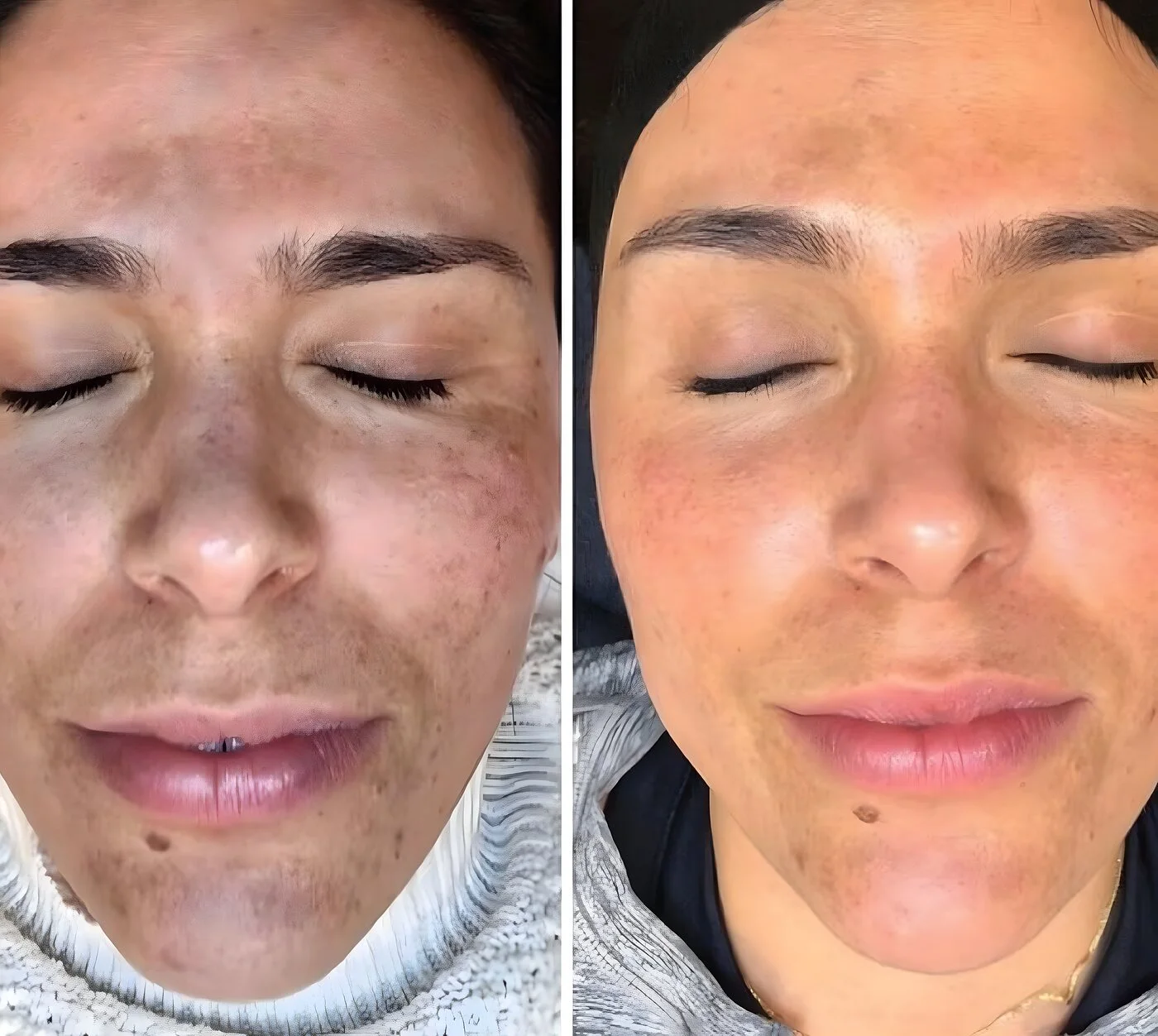 Chemical peel before and after showing facial sun damage and freckling refined to brighter, clearer skin.