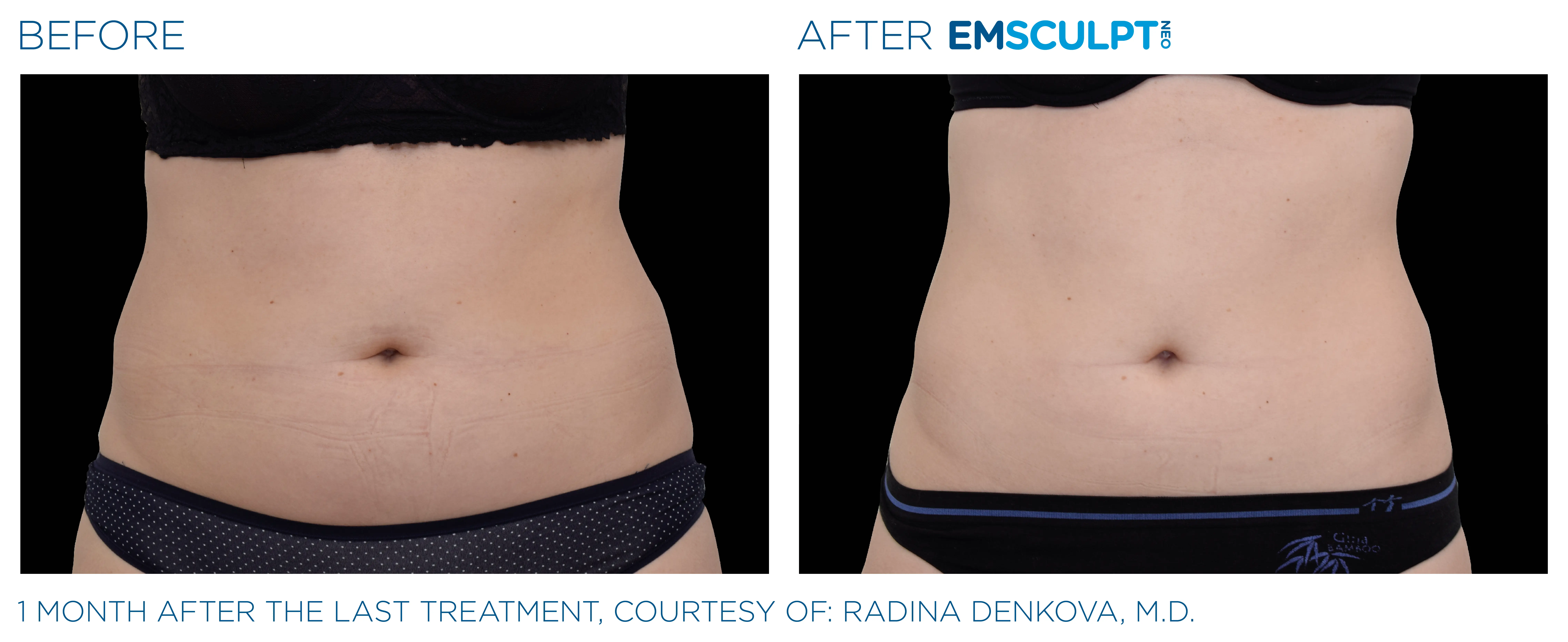 EmSculpt NEO before and after abdomen showing a flatter, more defined core