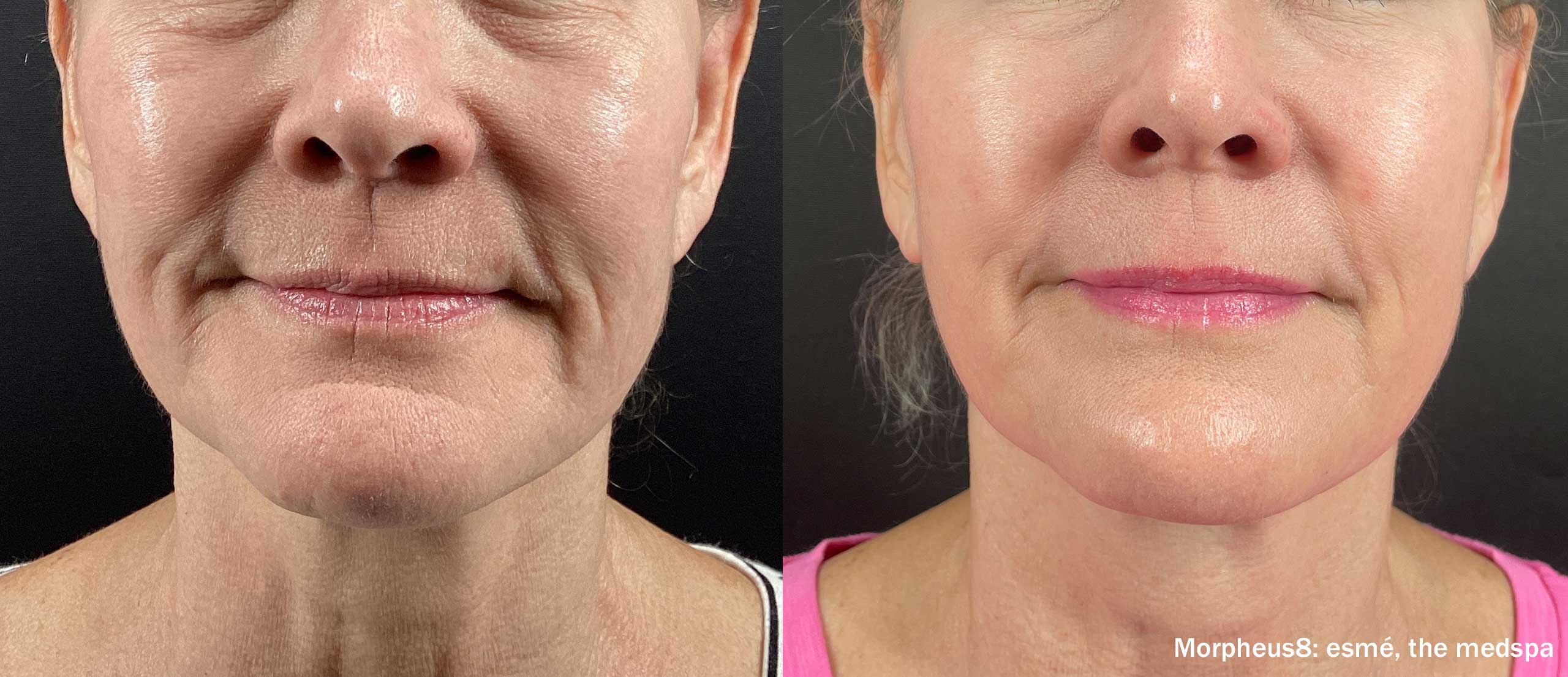 Morpheus8 RF microneedling skin tightening before and after results