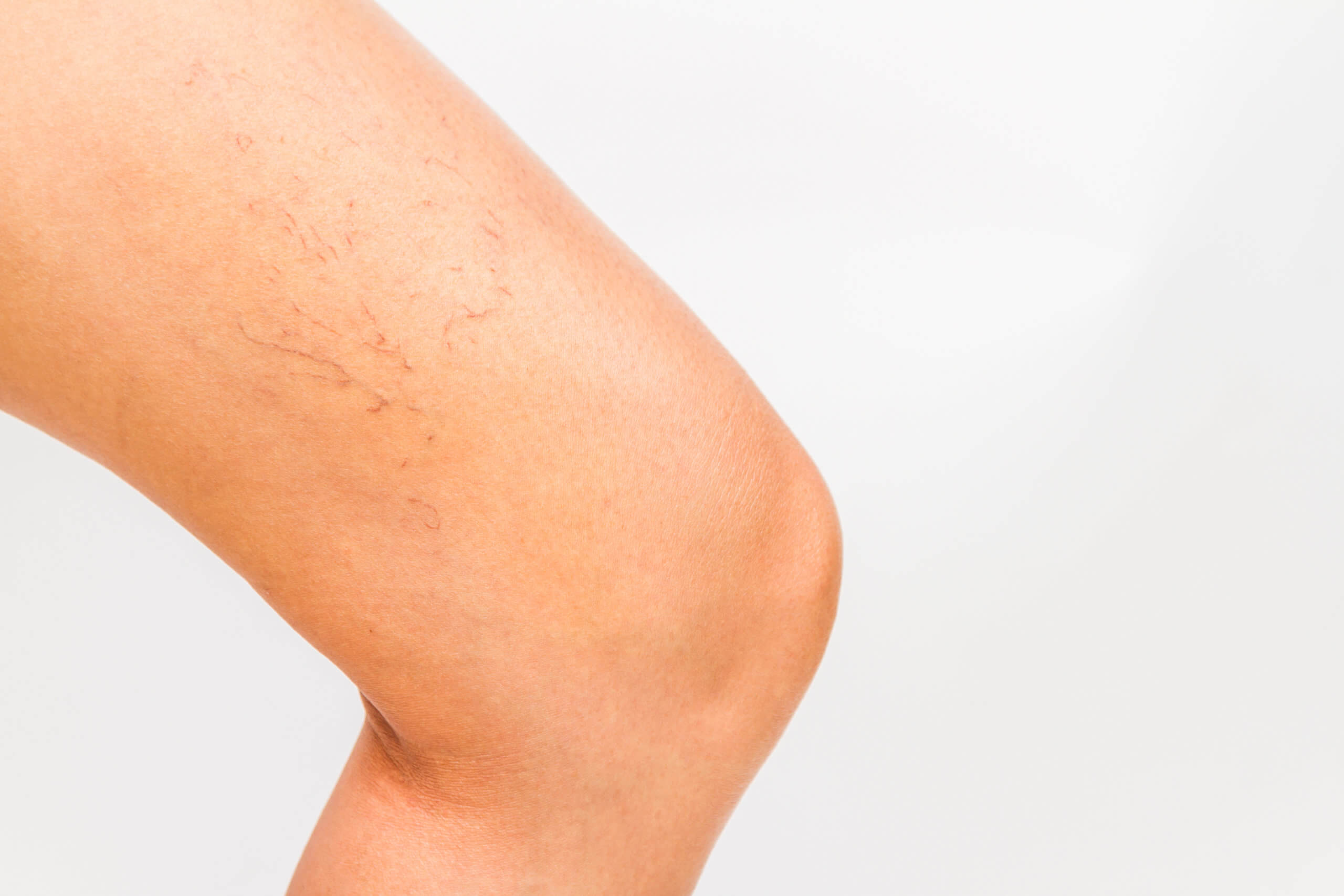 Sclerotherapy spider vein injection treatment in progress at Miami Skin Spa in Brickell