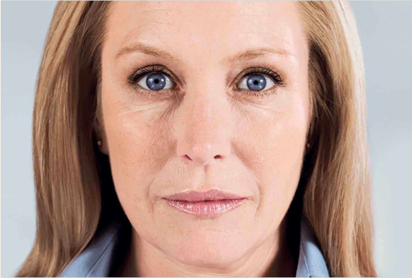 After Sculptra collagen treatment — restored lower-face firmness and improved jawline contour