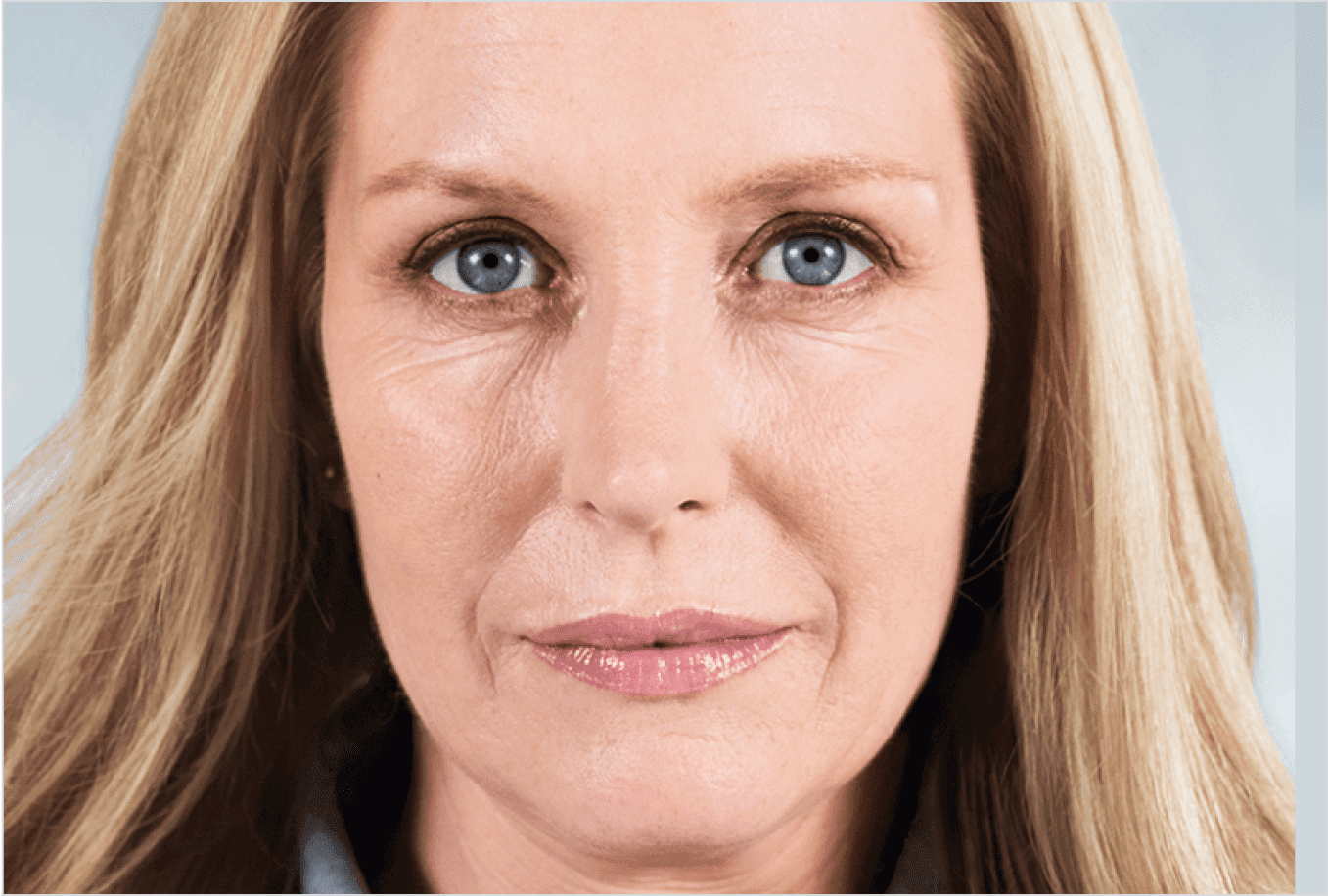 Before Sculptra collagen treatment — volume loss and laxity in the lower face and jawline