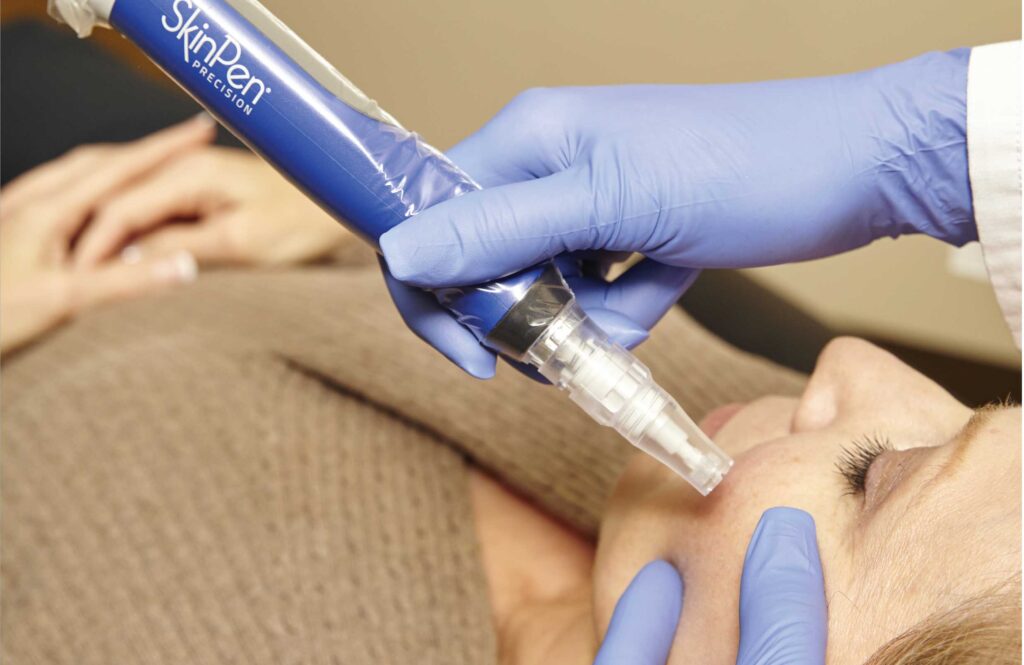 Microneedling treatment in progress, the base procedure exosome solutions are layered onto